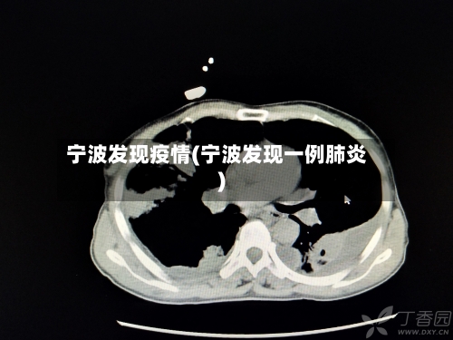 宁波发现疫情(宁波发现一例肺炎)-第2张图片