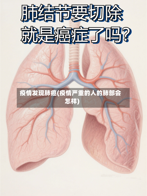 疫情发现肺癌(疫情严重的人的肺部会怎样)-第2张图片