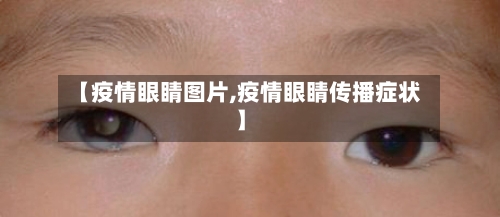 【疫情眼睛图片,疫情眼睛传播症状】-第1张图片