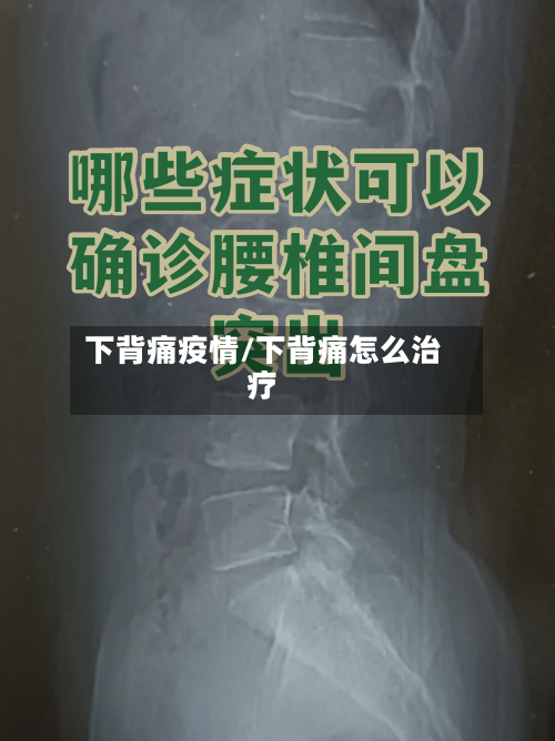 下背痛疫情/下背痛怎么治疗-第2张图片