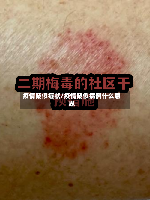 疫情疑似症状/疫情疑似病例什么意思-第3张图片