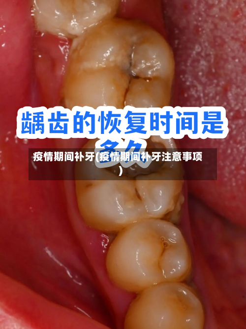 疫情期间补牙(疫情期间补牙注意事项)-第2张图片