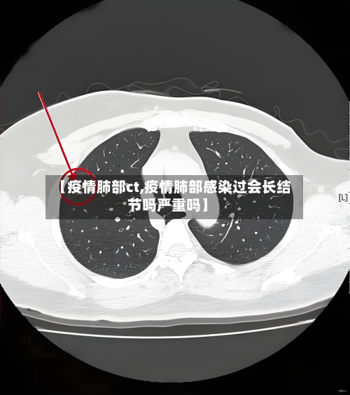 【疫情肺部ct,疫情肺部感染过会长结节吗严重吗】-第2张图片