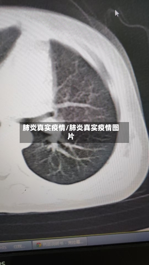 肺炎真实疫情/肺炎真实疫情图片-第1张图片